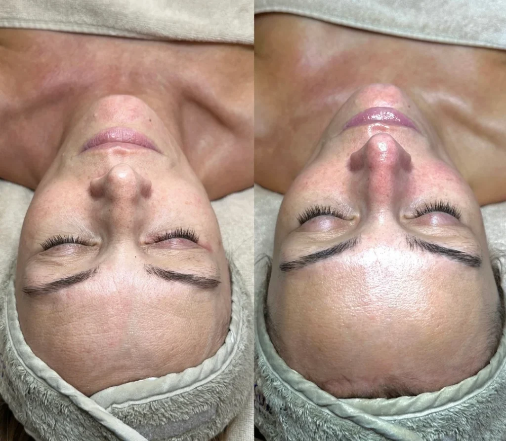 Monaco Glow Skin tretman Beograd – glow efekat